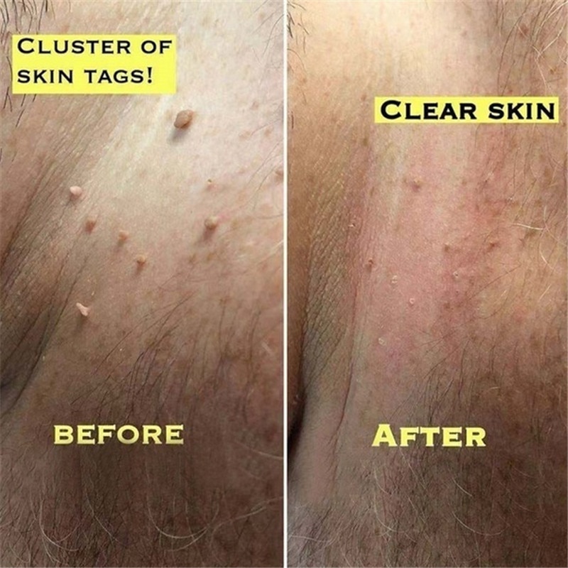 Health-Skin-Tag-Remover Genital Wart Mole Kill-Medical-Tu 12-Hours-Tu 3ml Natural